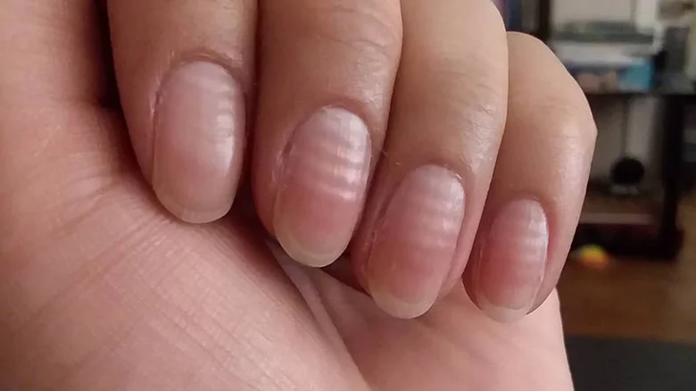 Неровности на ногтях